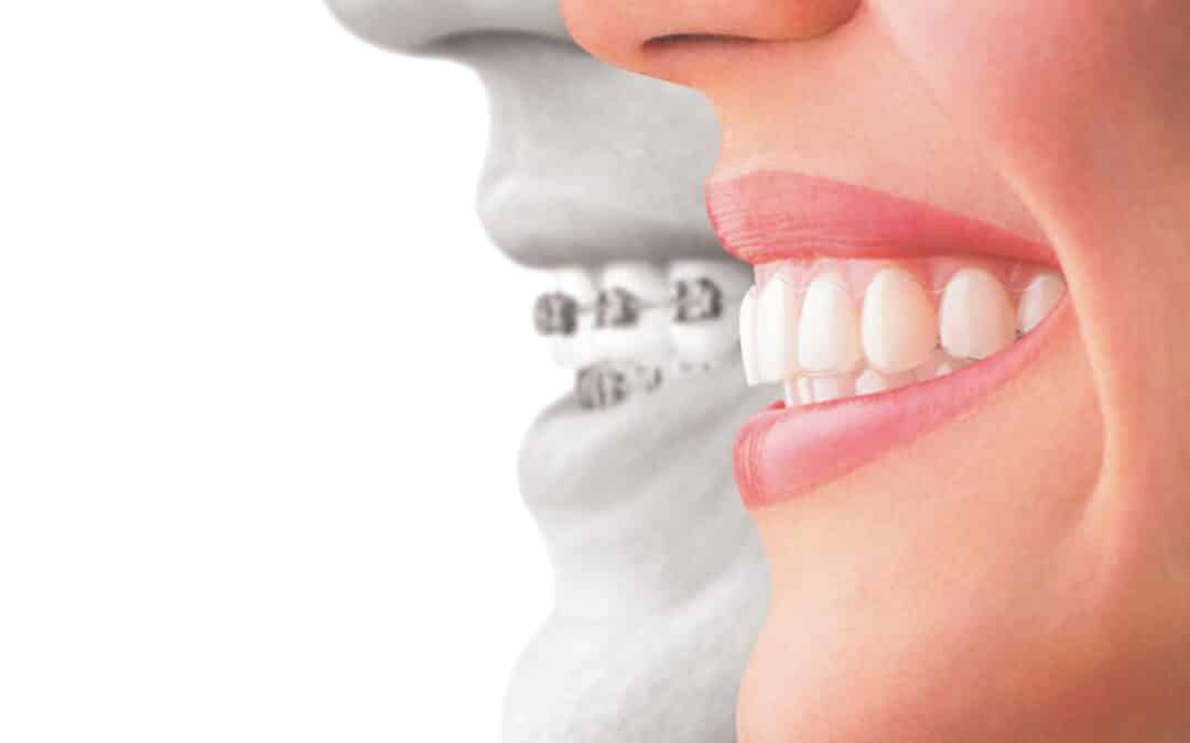 Ask Your Edna Dentist: What’s the difference between Invisalign and Metal Braces?