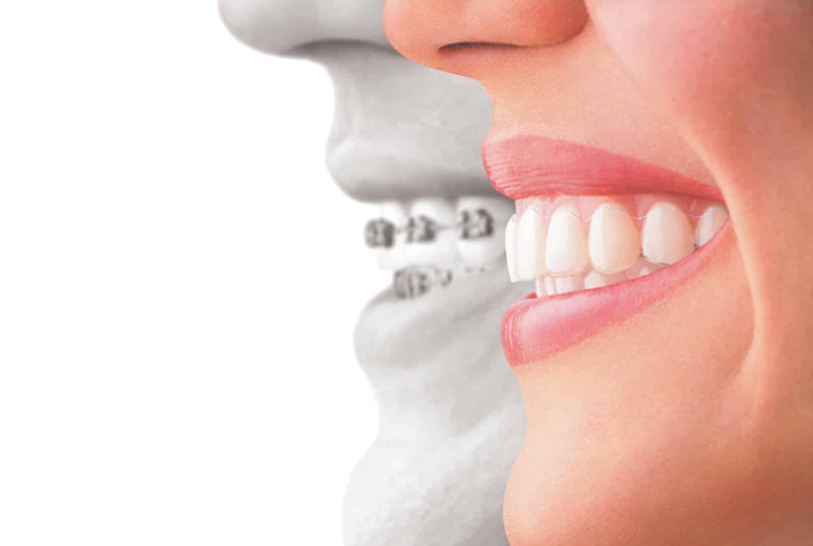 Should You Choose Ceramic Braces or Invisalign? Local Orthodontic Treatment