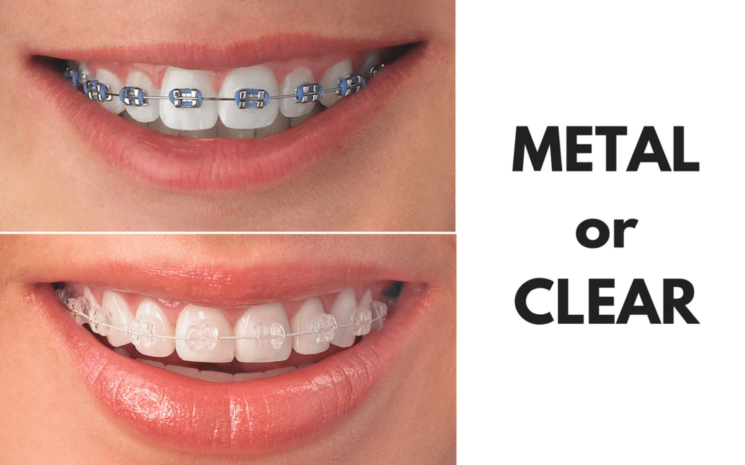 Ask Your Edna Dentist: Should I Get Metal or Clear Braces?